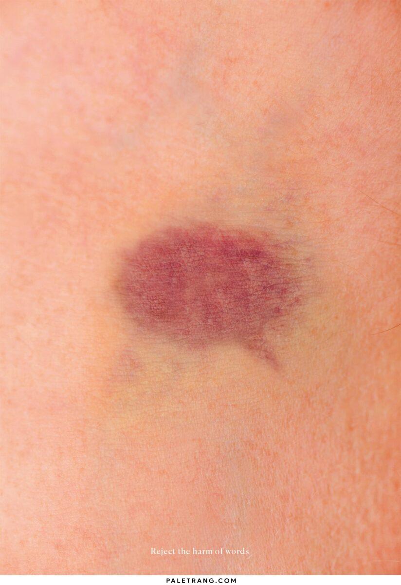 Bruise